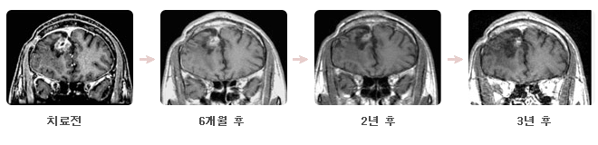 뇌수막증