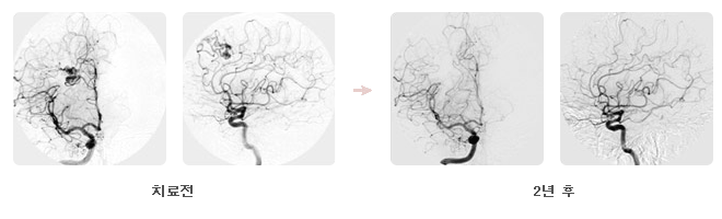 뇌동정맥기형 치료전, 2년후 비교사진