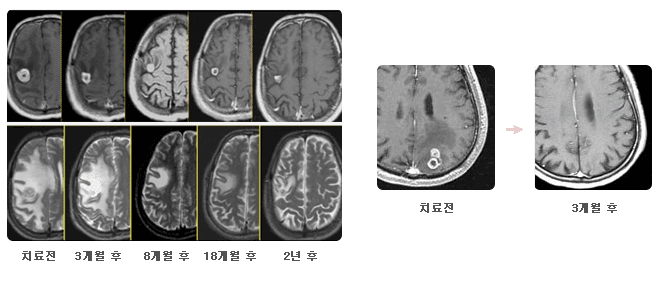 전이성뇌종양 치료전과 3개월후 사진