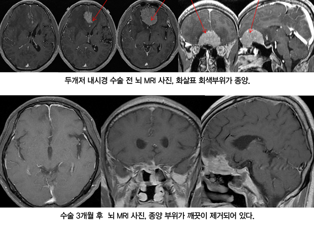 이호천 씨의 두개저 내시경 수술 전 후 MRI 사진.