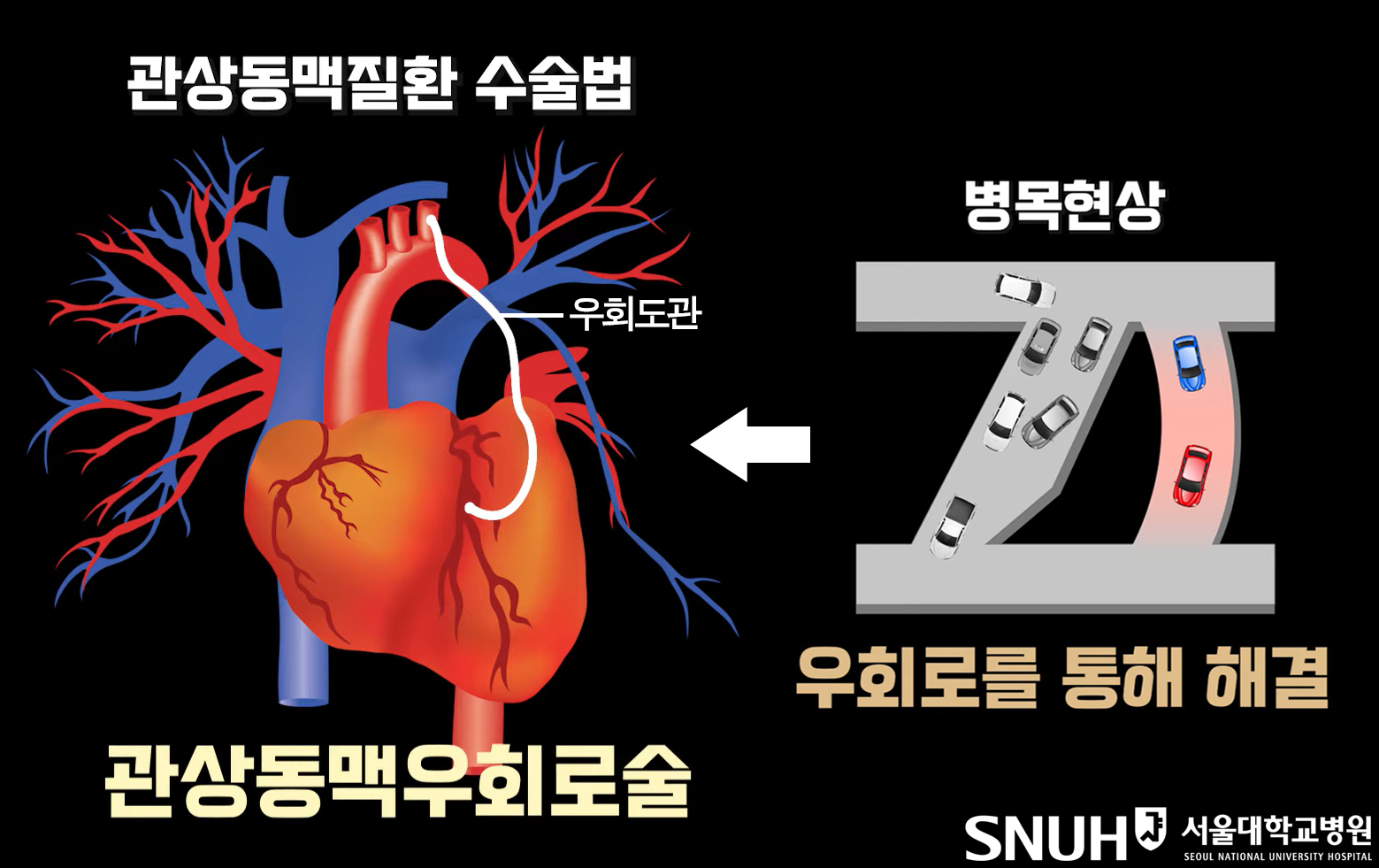 [병원뉴스][SNUH건강정보] 좁아진 관상동맥, 새 혈관길 내서 치료한다