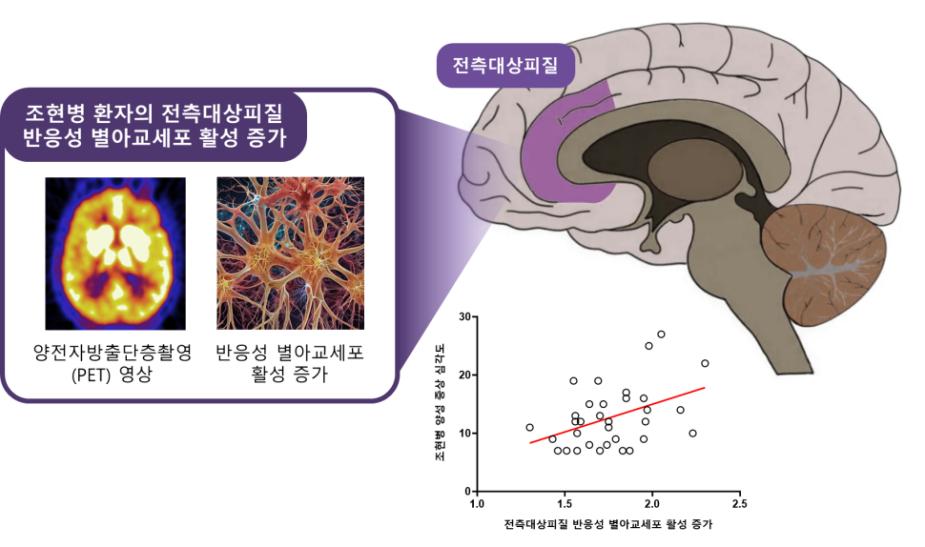 [병원뉴스]조현병 증상 새로운 원인 지표, 뇌 속 '반응성 별아교<!HS>세포<!HE>' 활성 증가