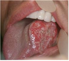 혀 측면에 생긴 구강암