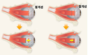 사시수술