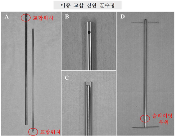 이중 교합 신연 골수정 