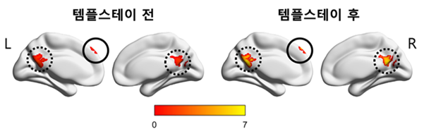 템플스테이 참가자들이 대조군에 비해 템플스테이 수행 후 디폴트모드 네트워크를 이루는 쐐기앞소엽(precuneus, 점선)와 내측상전두엽(실선) 부분의 강도가 유의하게 증가했다. (붉은색에서 노란색으로 변할수록 강도 증가) 