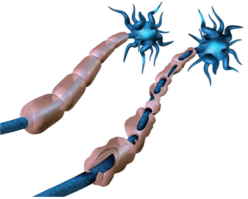 다발성경화증은 신경을 둘러싸고 있는 수초가 면역질환 이상으로 손상되어(오른쪽) 뇌에서 나오는 신경자극 전달이 방해될 때 나타난다. 