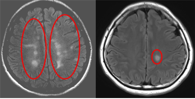 90년대에 출생한 다발성경화증 환자의 뇌 MRI 사진(왼쪽)은 (오른쪽)70년대 출생환자 보다 하얗게 변화된 뇌염증이 초기부터 전체에 퍼져 있다. 