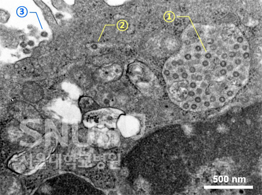 그림 1. 신종 코로나바이러스에 감염된 세포(Vero cell)의 전자현미경 사진으로 신종 코로나바이러스의 생활사를 보여준다. ① 세포 내에 가득 모여 있는 바이러스 입자, ② 세포 밖으로 이동 중인 바이러스 입자, ③ 세포 밖으로 터져 나온 바이러스 입자 (서울대병원 감염내과 제공)