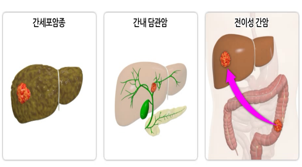 간암