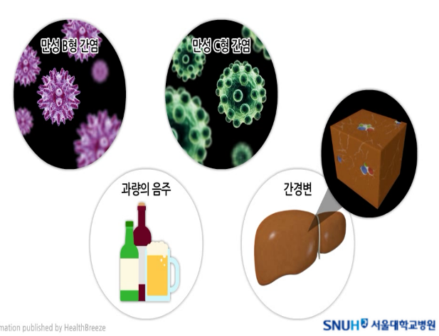 간암_원인