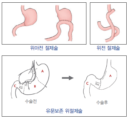 위암