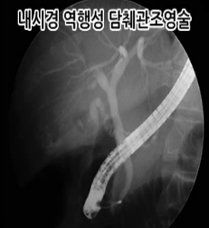 ERCP