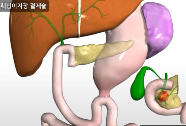 췌장암