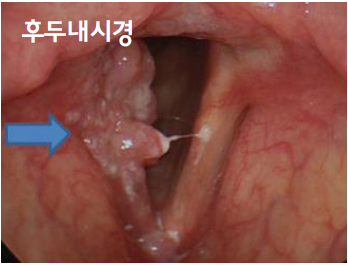 후두