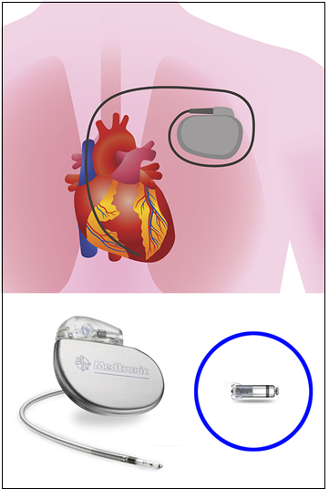 몸에 삽입하는 전선이 달린 인공심박동기와 대퇴 정맥을 통해 시술로 삽입하는 메트로닉社 무선 심박동기 ‘마이크라’(파란색 원 안)