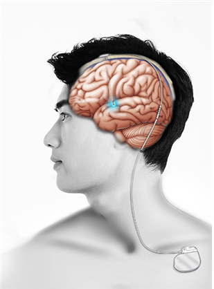 뇌심부자극술로 자극용 전극을 삽입한 모식도