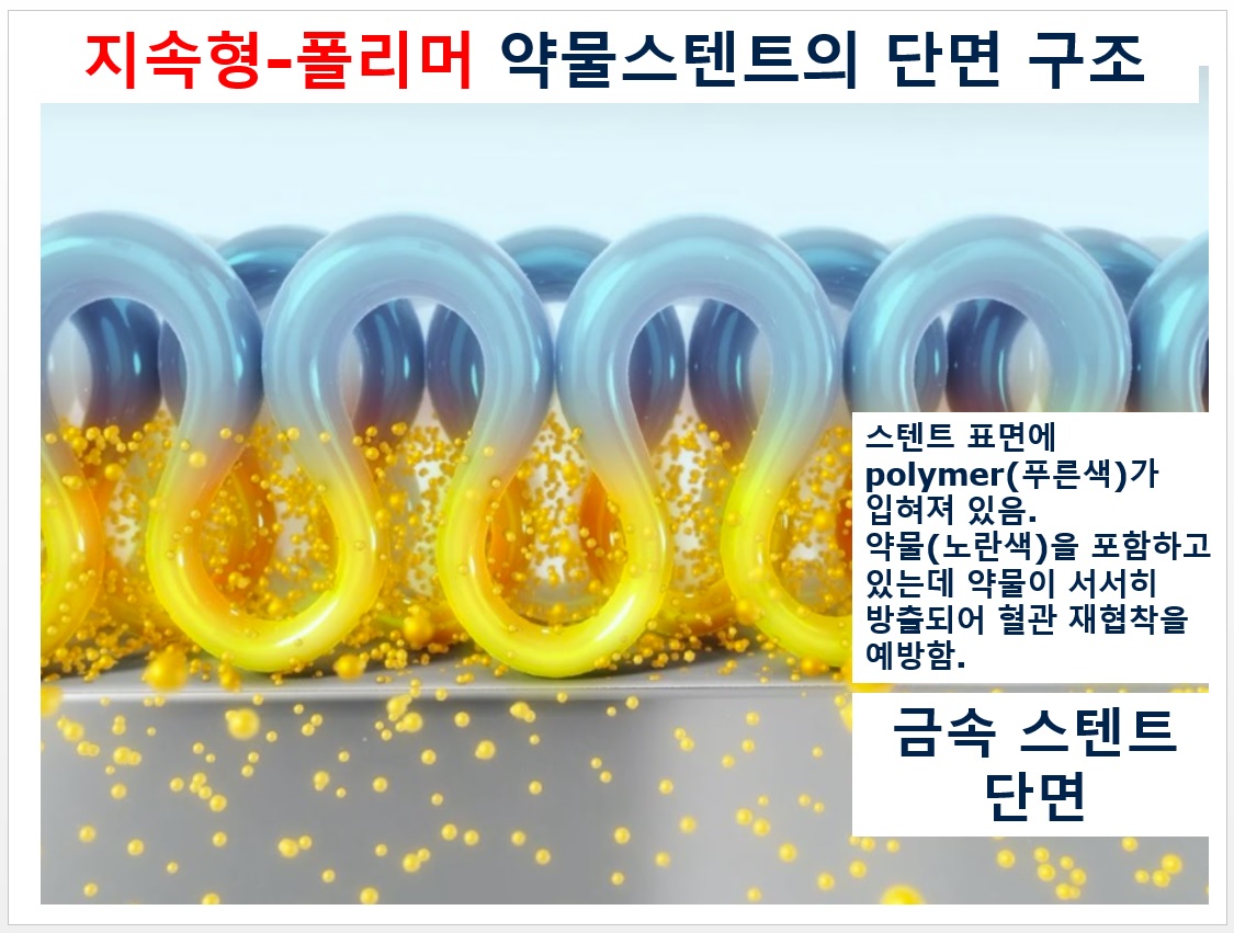 지속형-폴리머 약물스텐트의 단면구조