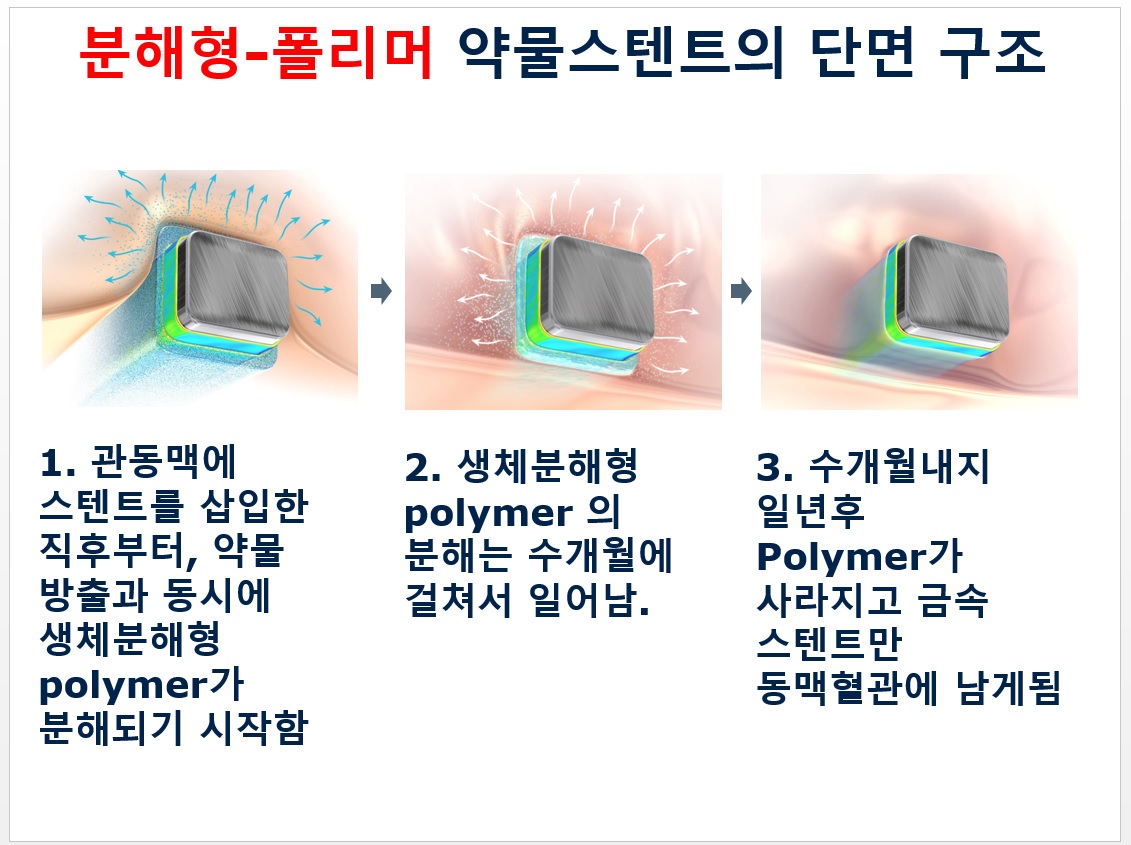 분해형-폴리머 약물스텐트의 단면 구조