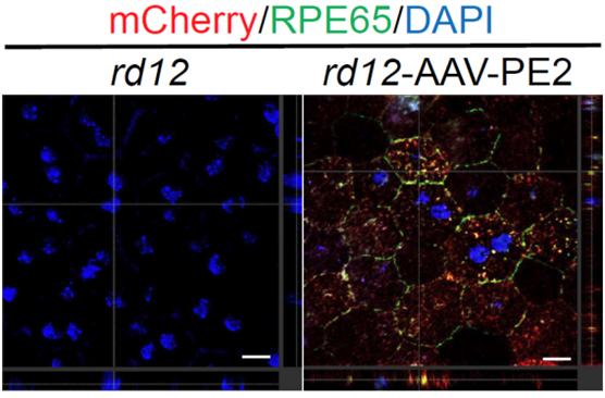 그림 1. 프라임 교정기를 통해 망막색소상피세포 내 RPE65 단백질 발현 회복(오른쪽) 효과 확인.