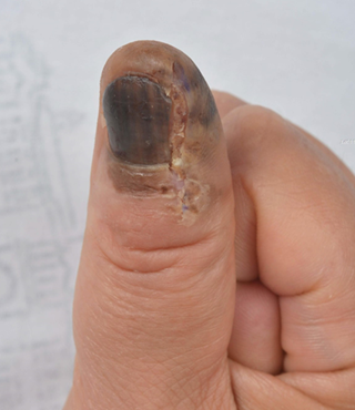 NEWS(Subungual Melanoma (SUM) under the nail and toenail, risk varies by location) | SEOUL NATIONAL UNIVERSITY HOSPITAL NEWS(Subungual Melanoma (SUM) under the nail and toenail, risk varies by location) | SEOUL NATIONAL UNIVERSITY HOSPITAL