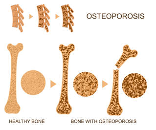 그림 1. 골다공증