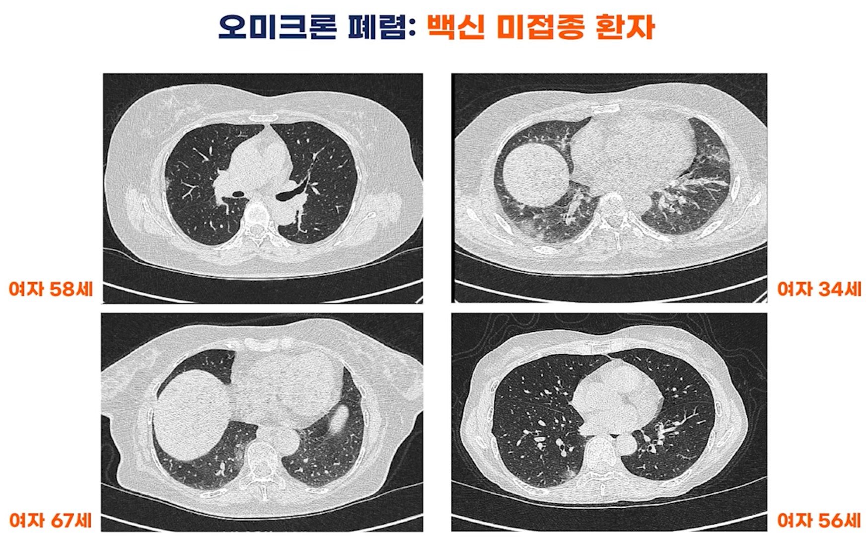 [자료5] 오미크론 환자 폐CT