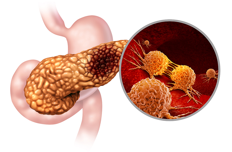 췌장암 모식도