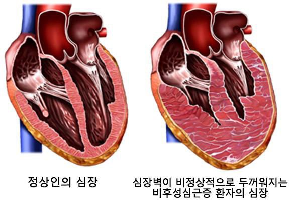 비후성심근증 모식도