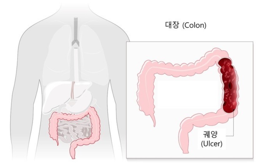 [사진] 궤양성 대장염