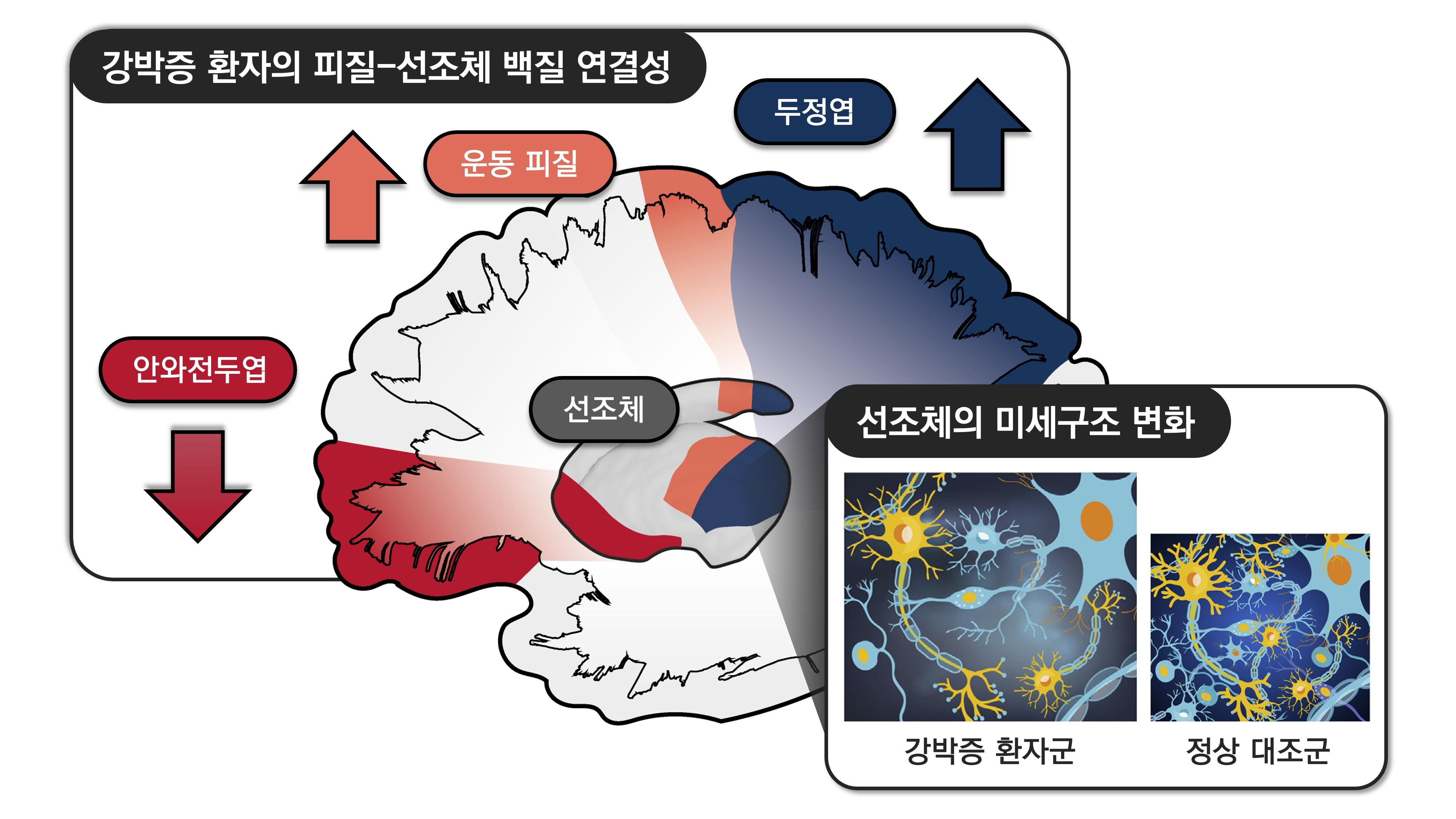 [이미지] 강박증 환자에서 관찰한 대뇌 피질-선조체 회로의 변화. 