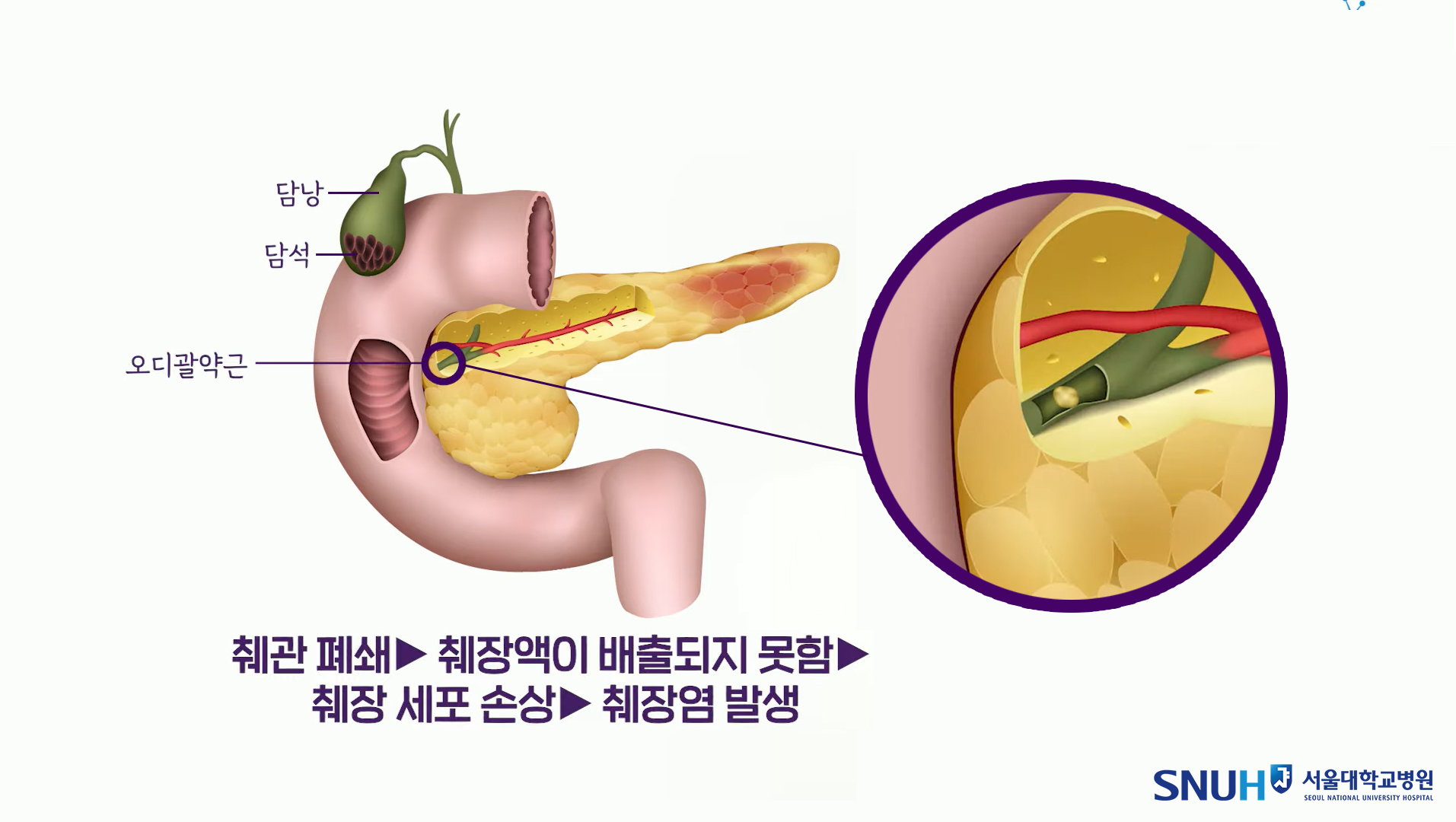 담석이 오디 괄약근에 박혀 췌관을 폐쇄할 경우, 십이지장으로 배출되지 못한 췌장액이 췌장 세포를 손상시켜 염증을 유발한다.