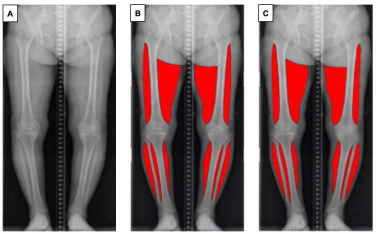 X-ray 사진