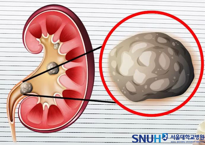 요로결석의 발생 사진
