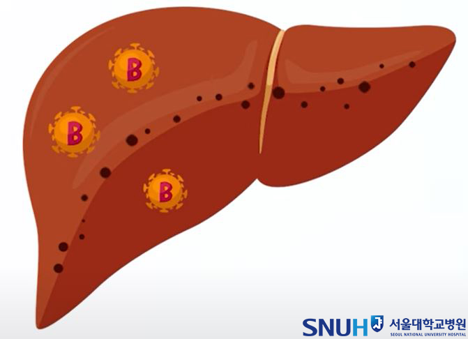 B형간염 바이러스 