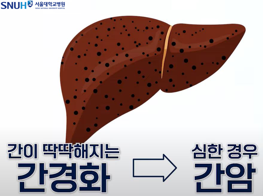 간경화, 간암으로 이어지는 B형간염 