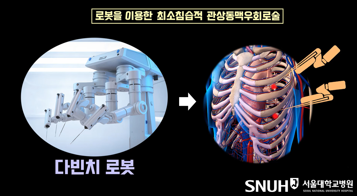 다빈치 로봇을 이용한 최소침습적 관상동맥우회로술
