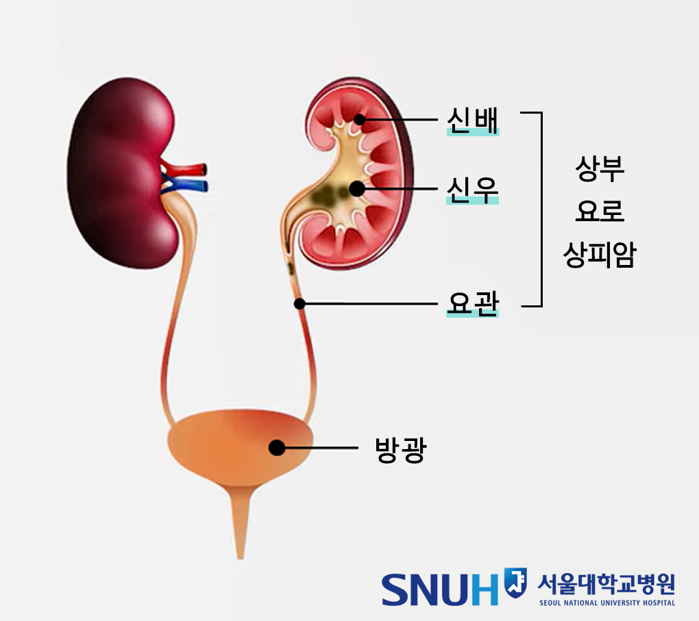 상부요로상피암