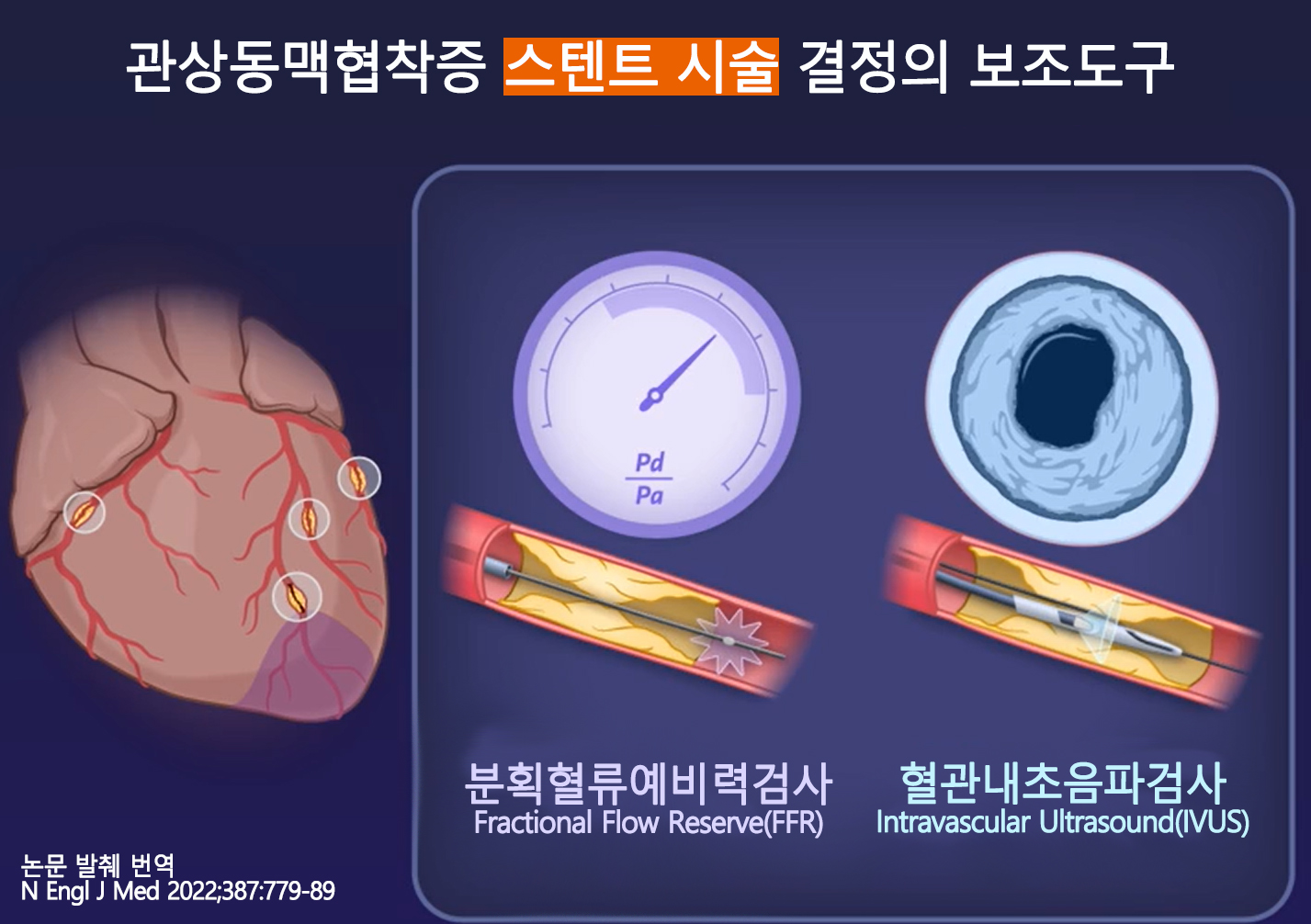 관상동맥협착증 스텐트 시술 결정의 보조도구(출처: NEJM)