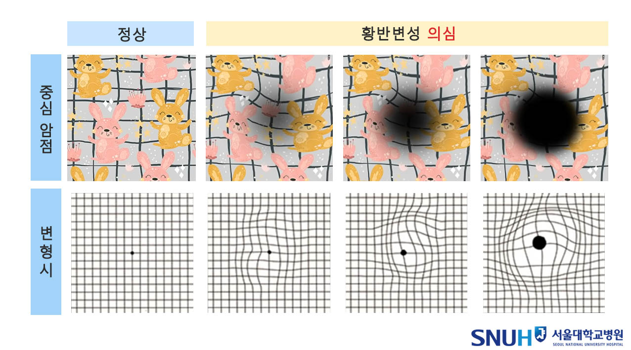 황반변성 전조증상 2가지. 물체 중심이 보이지 않는 중심 암점과 사물이 휘어 보이는 변형시는 황반변성의 대표적인 증상이다.