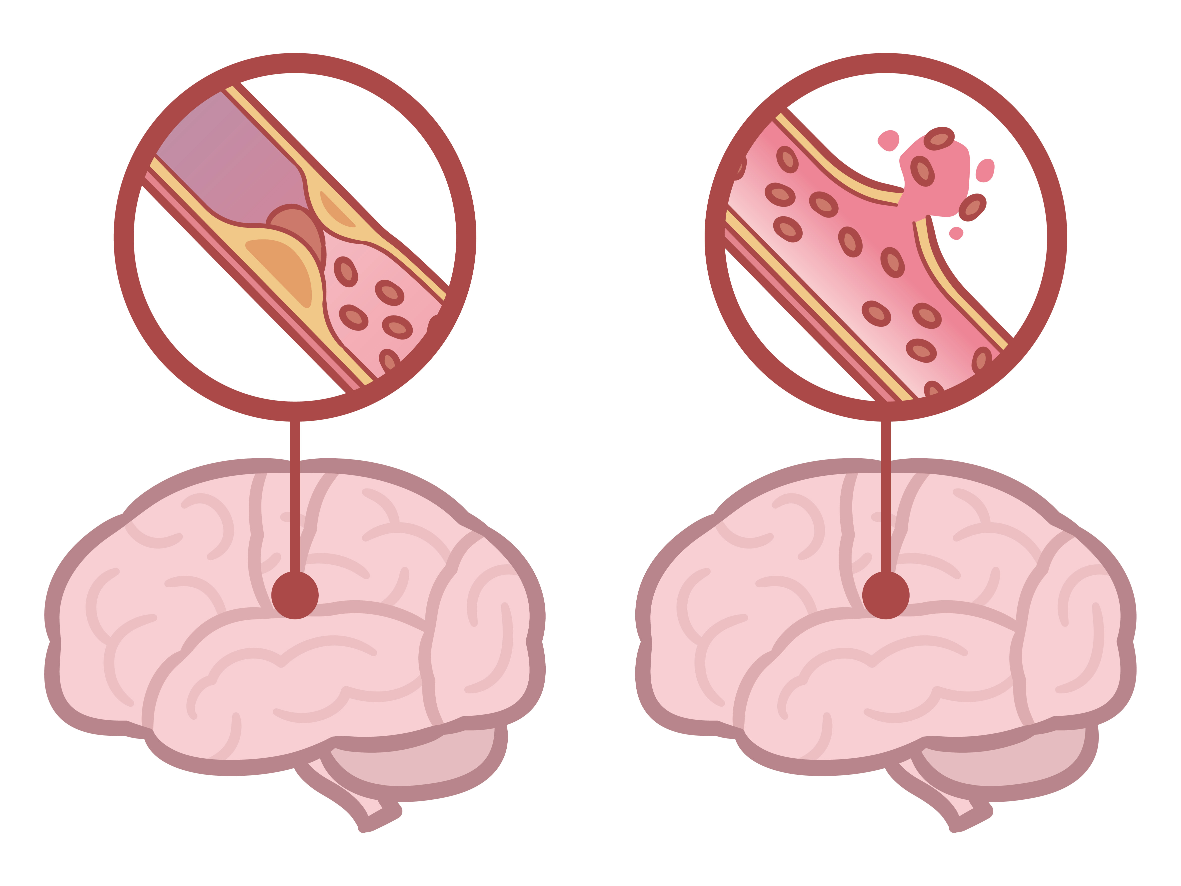 뇌졸중 (뇌경색(좌), 뇌출혈(우)) 출처: 게티이미지뱅크