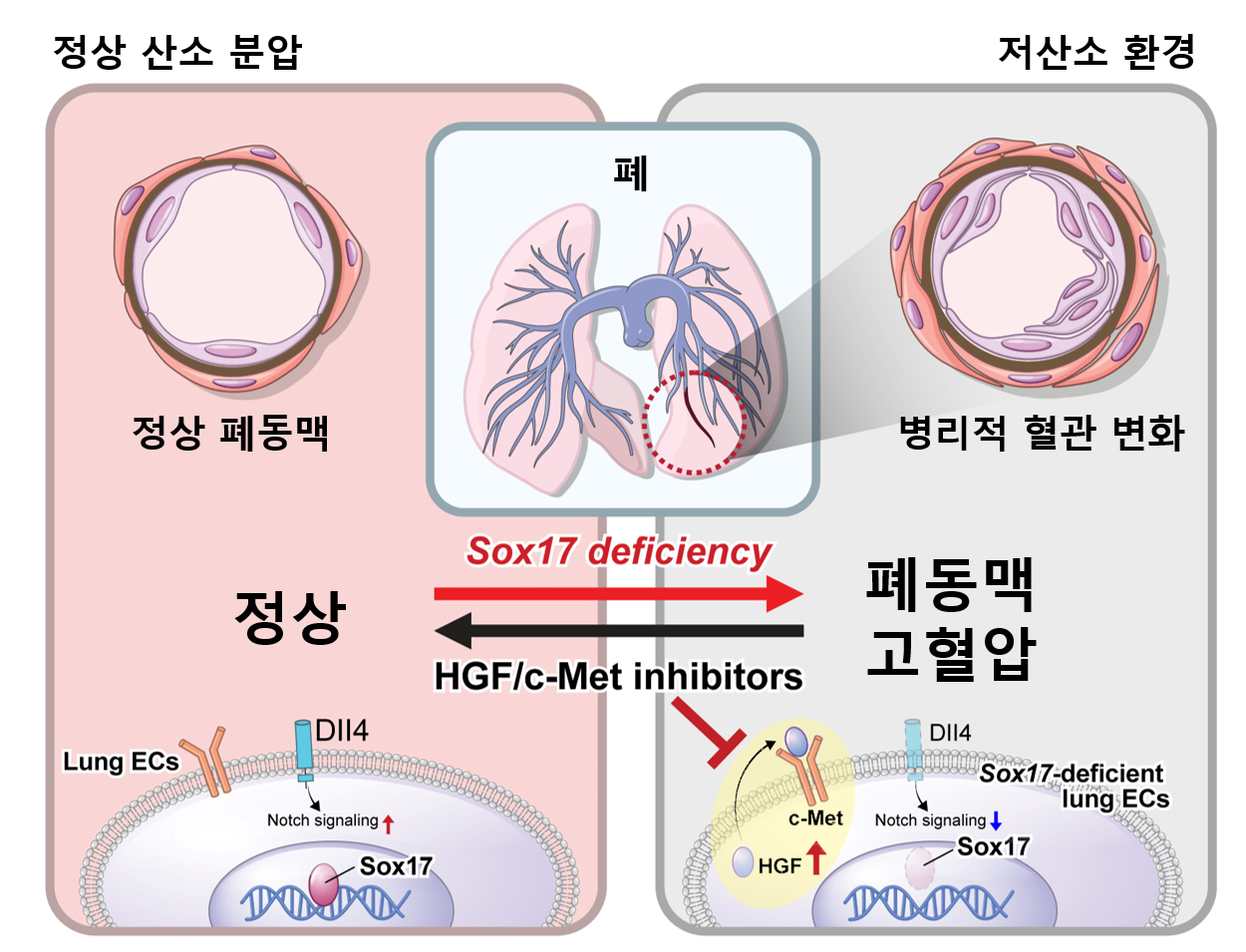 Sox17 유전자 결핍 시 저산소 환경에서 폐동맥 고혈압으로 이어지는 그림