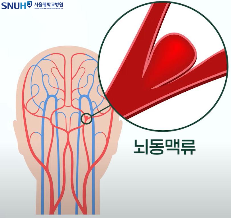 뇌동맥류