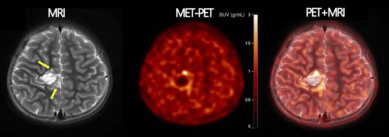 7세 남아의 MRI 및 MET-PET 영상