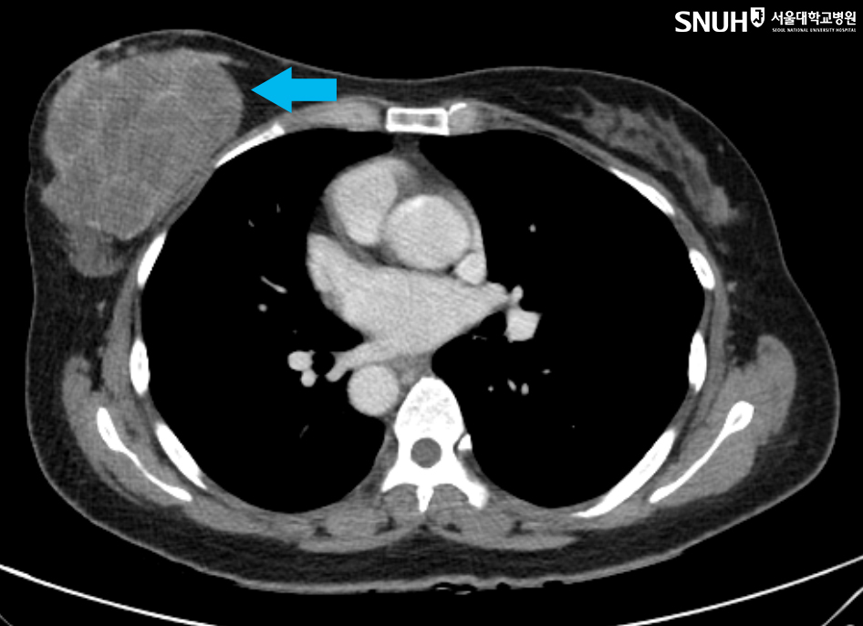 악성 엽상종(화살표) 환자의 CT사진