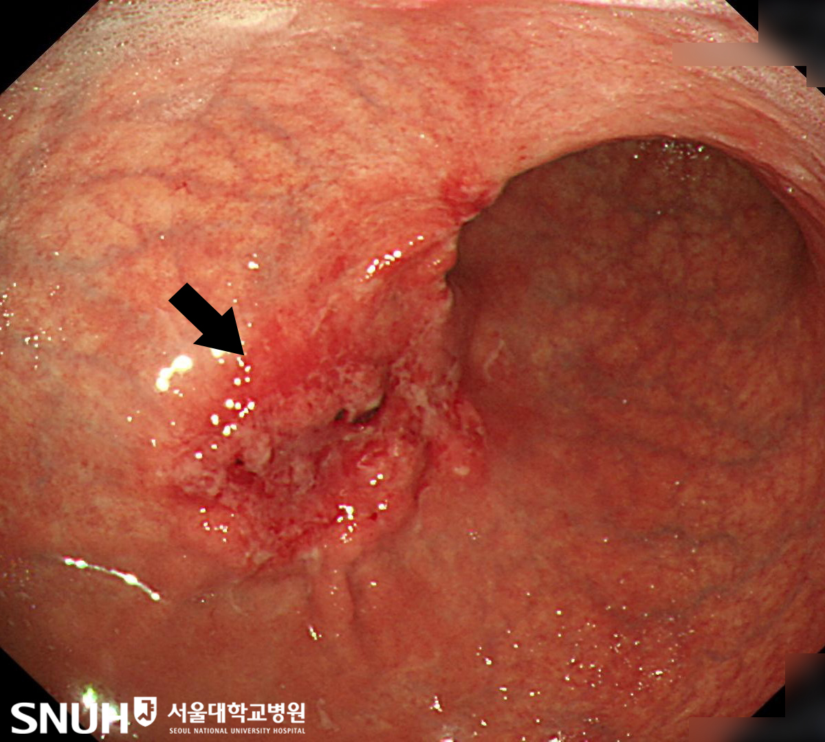 위암 환자의 CT영상