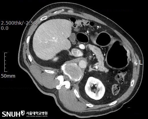 위암 환자의 CT영상