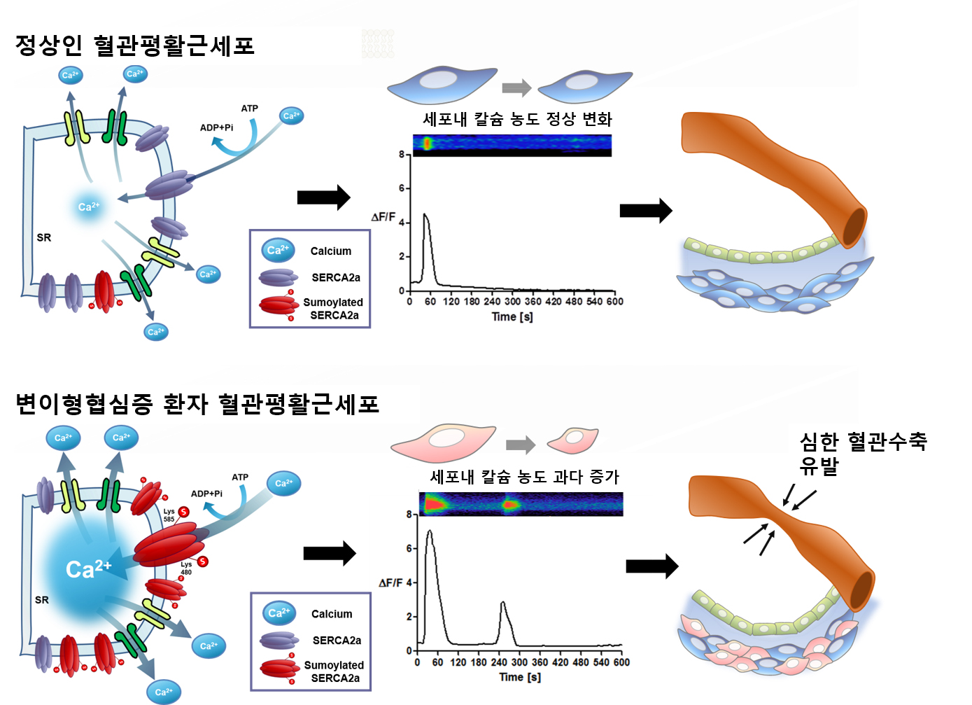 혈관 평활근세포의 정상 수축기전(위) 및 변이형 협심증 환자의 과도한 수축기전(아래) 