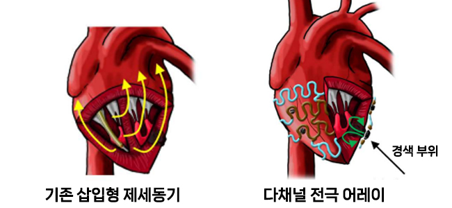 삽입형 제세동기와 다채널 전극 어레이의 구조 