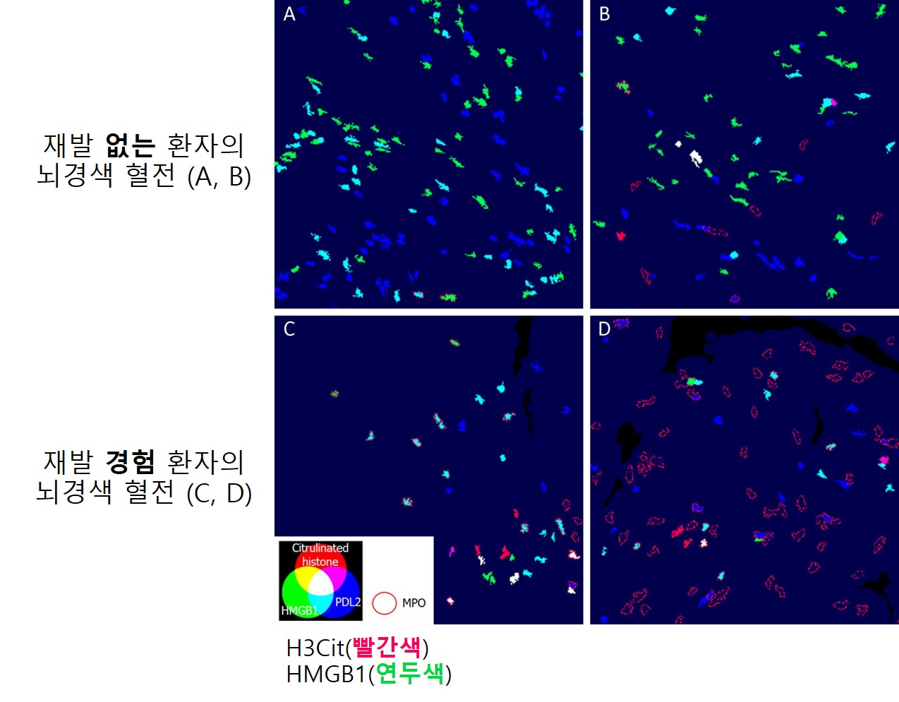 재발군의 혈전(C,D)에서는 대조군(A,B)에 비해 HMGB1 발현이 적고, H3Cit 발현이 증가했다.